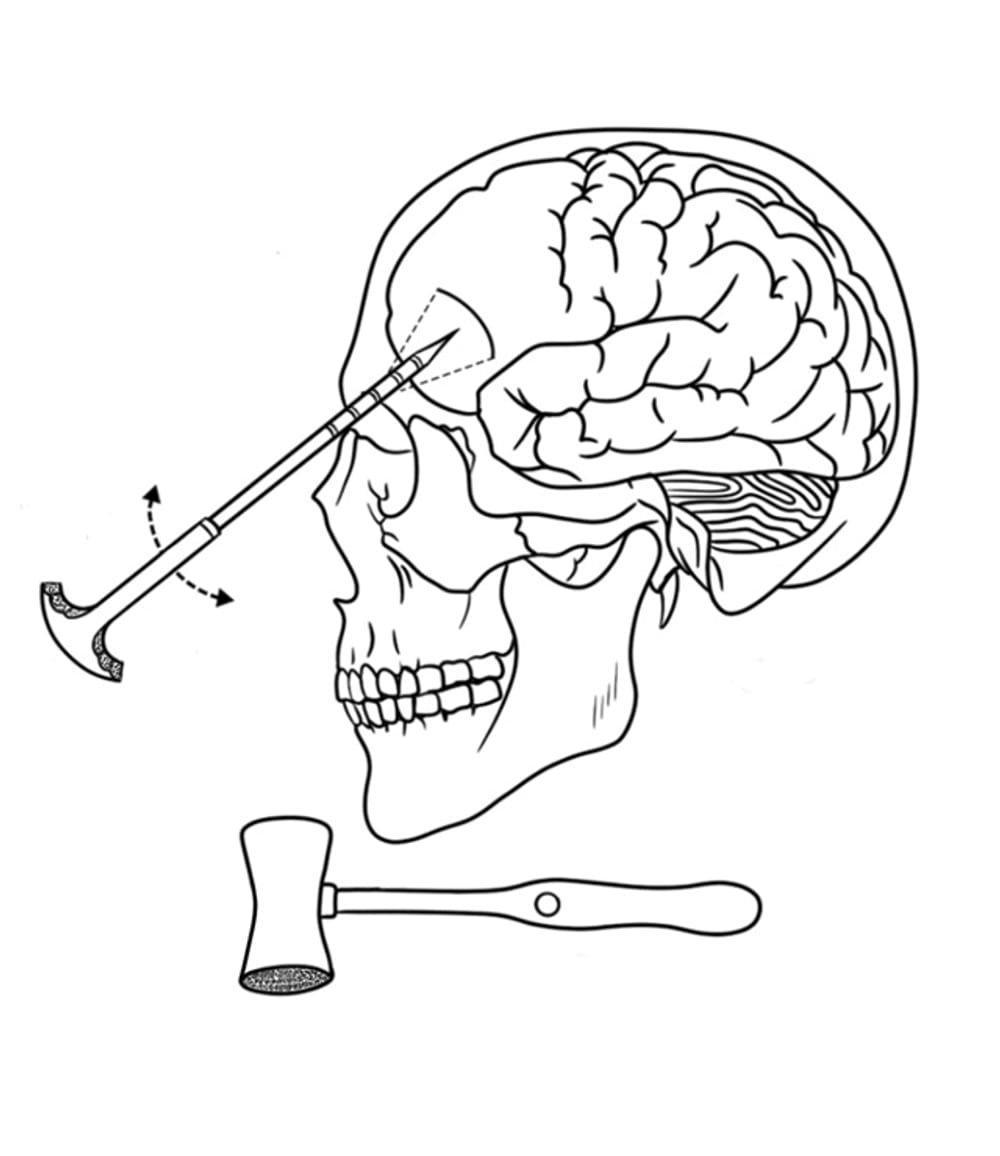 Lobotomy
