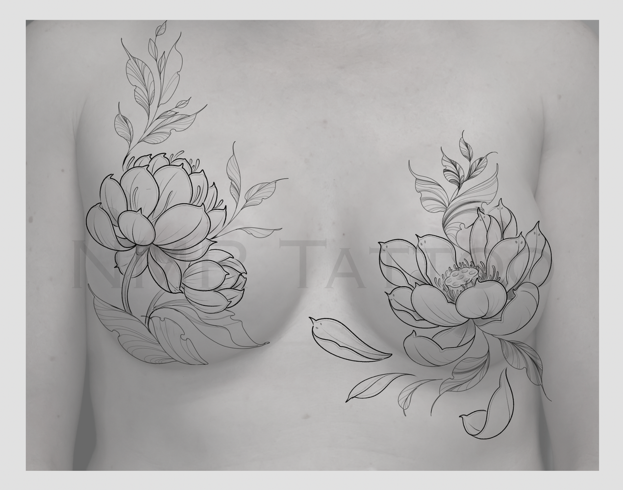 Lotus Bilateral Mastectomy